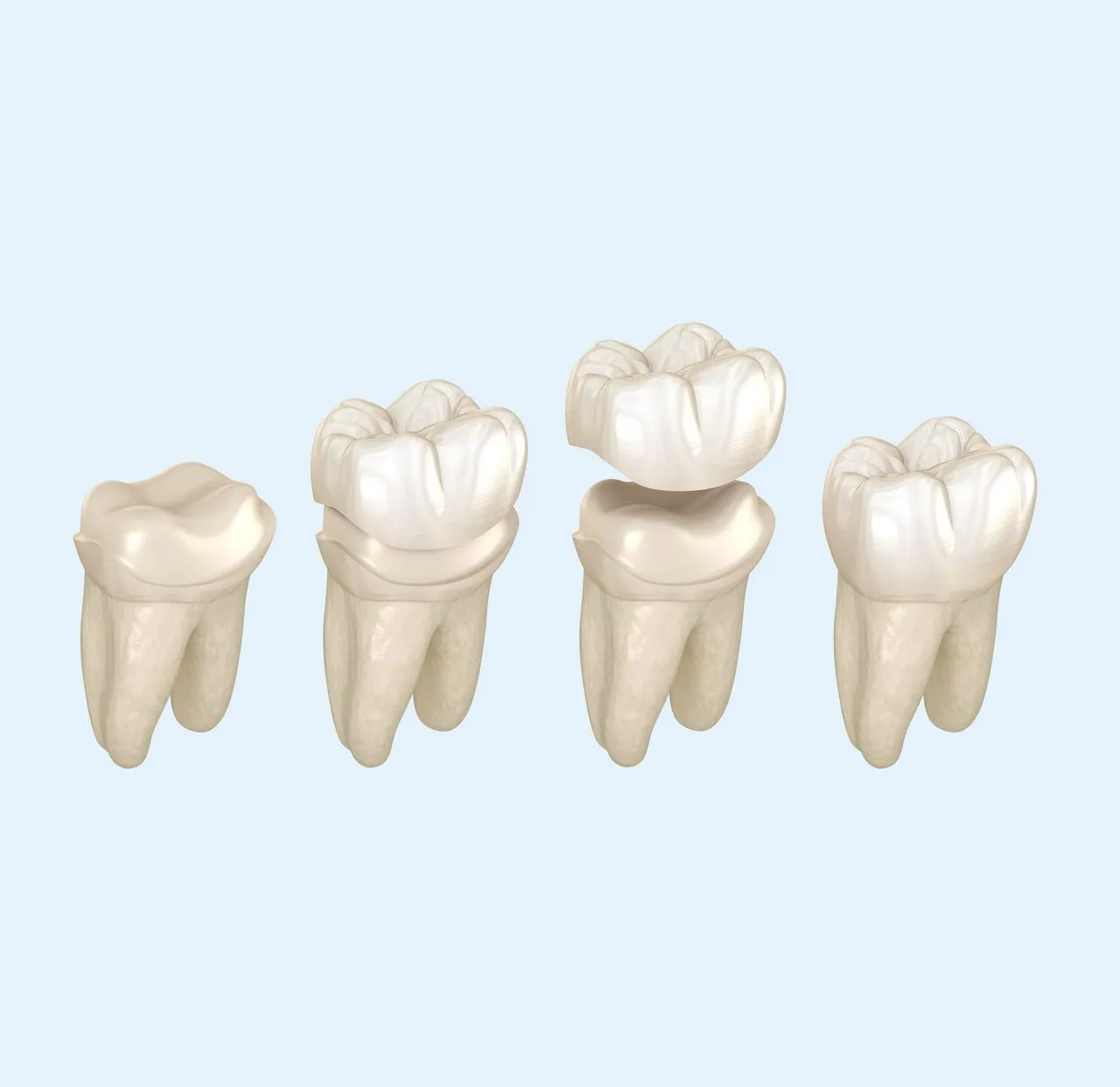 Veneers und Kronen bei größeren Defekten