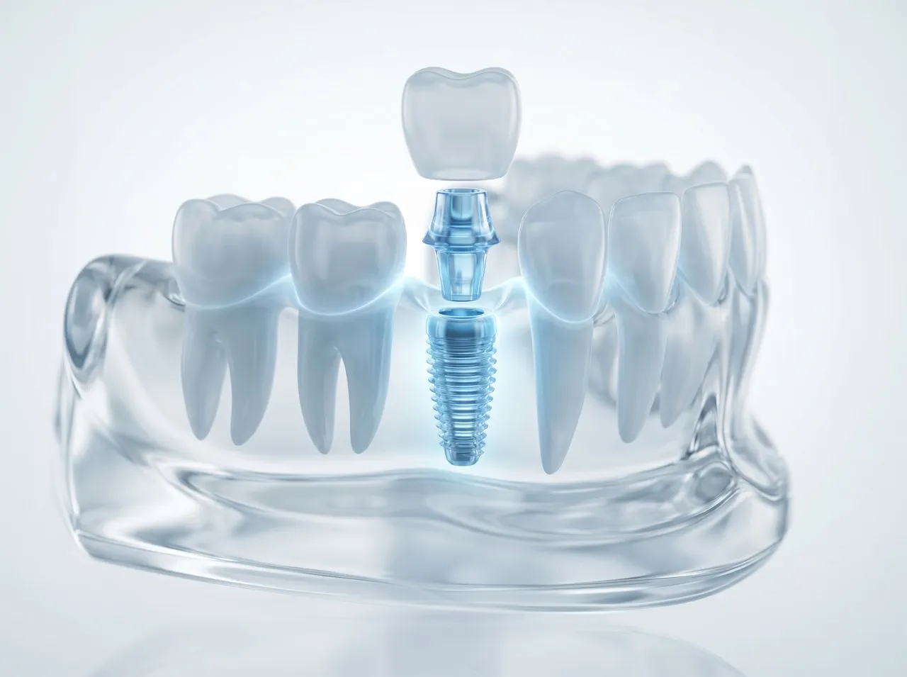 Zahnersatz und Implantate richtig pflegen