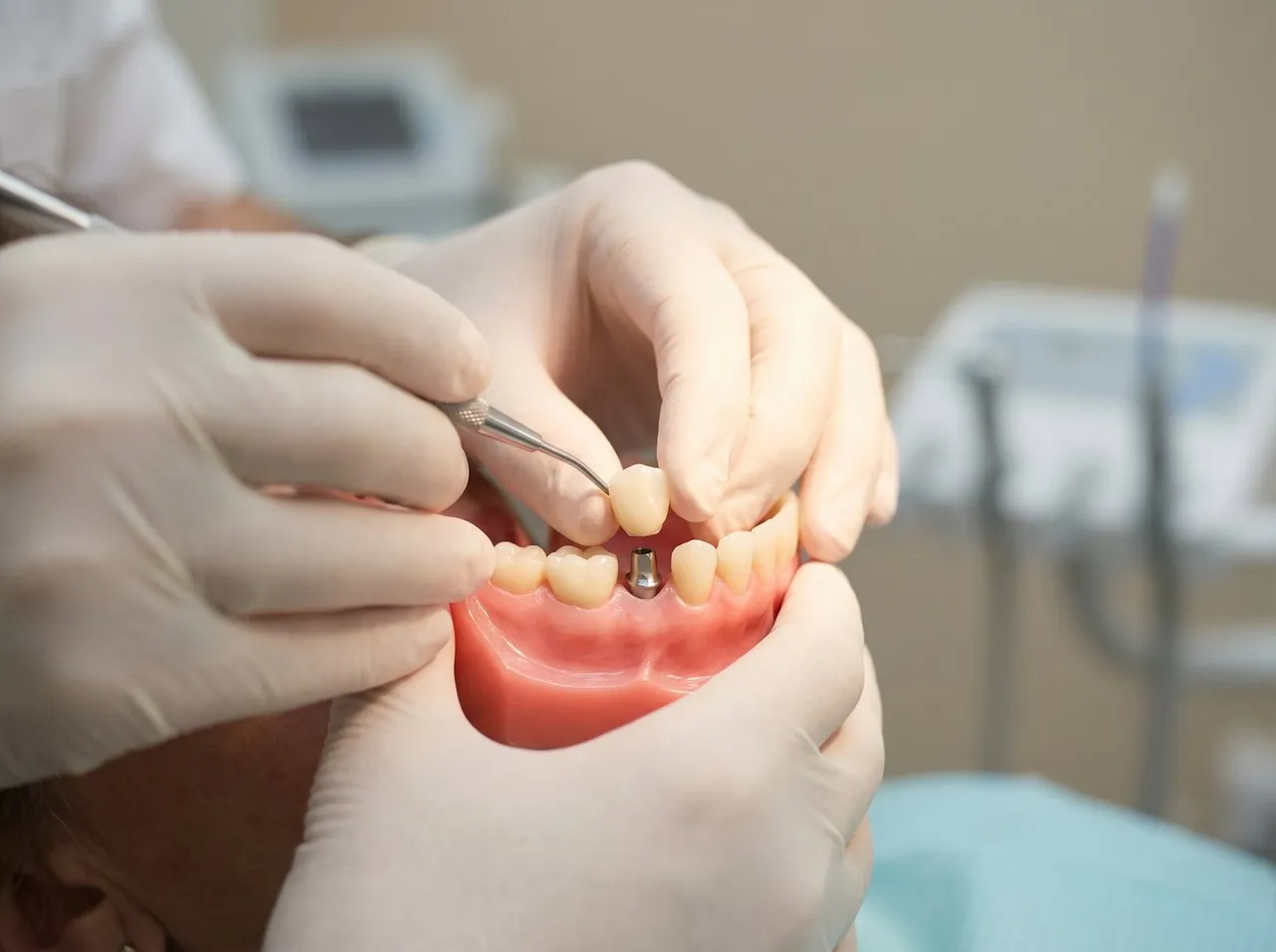 Implantat oder Krone: Was wird eigentlich ersetzt?