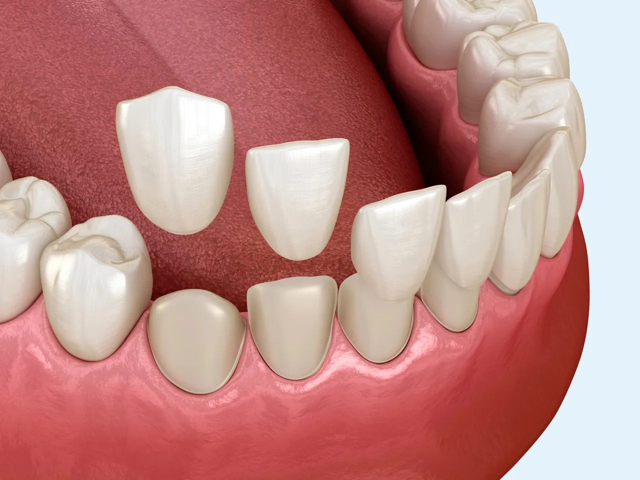 Welche Veneer-Arten schließen eine Zahnlücke?