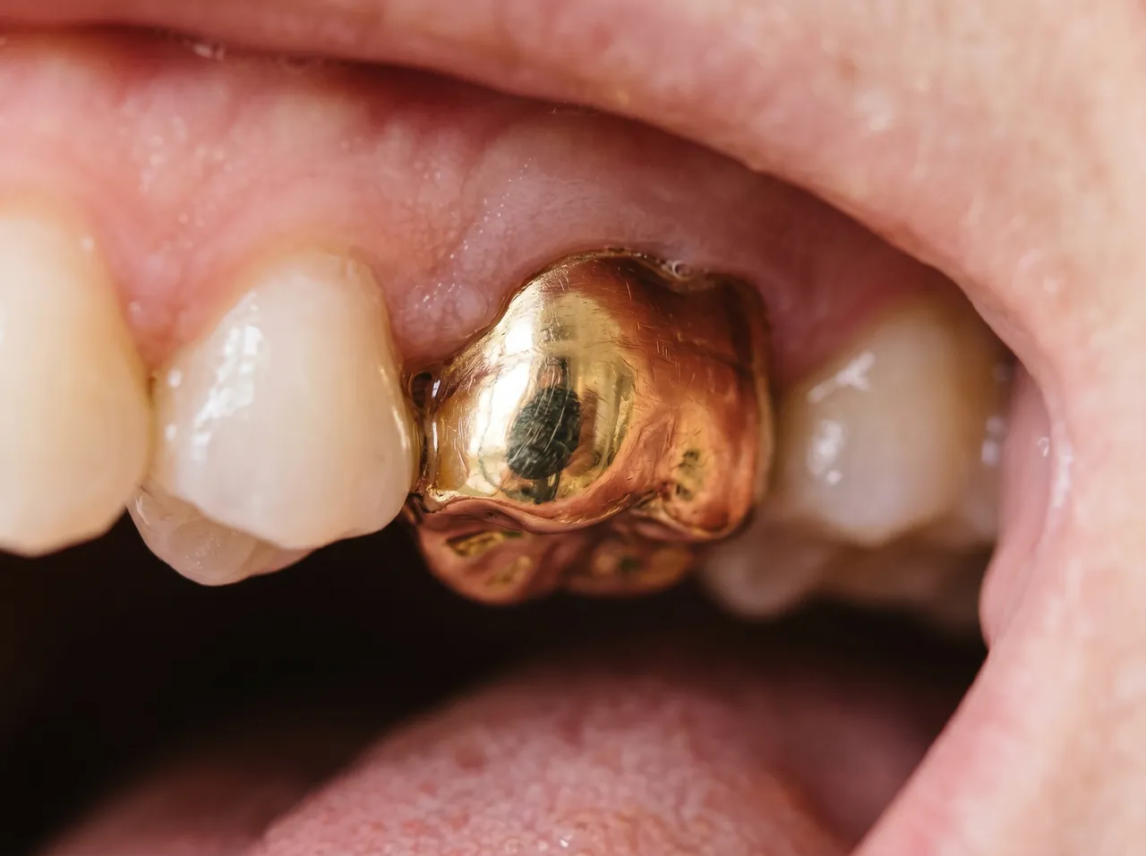 Was ist eine Goldfüllung?