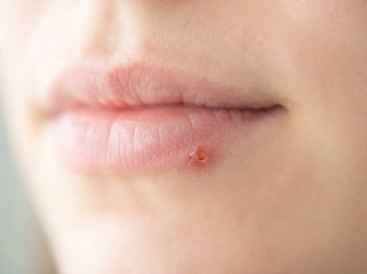 Mundherpes bei Kindern und in der Schwangerschaft