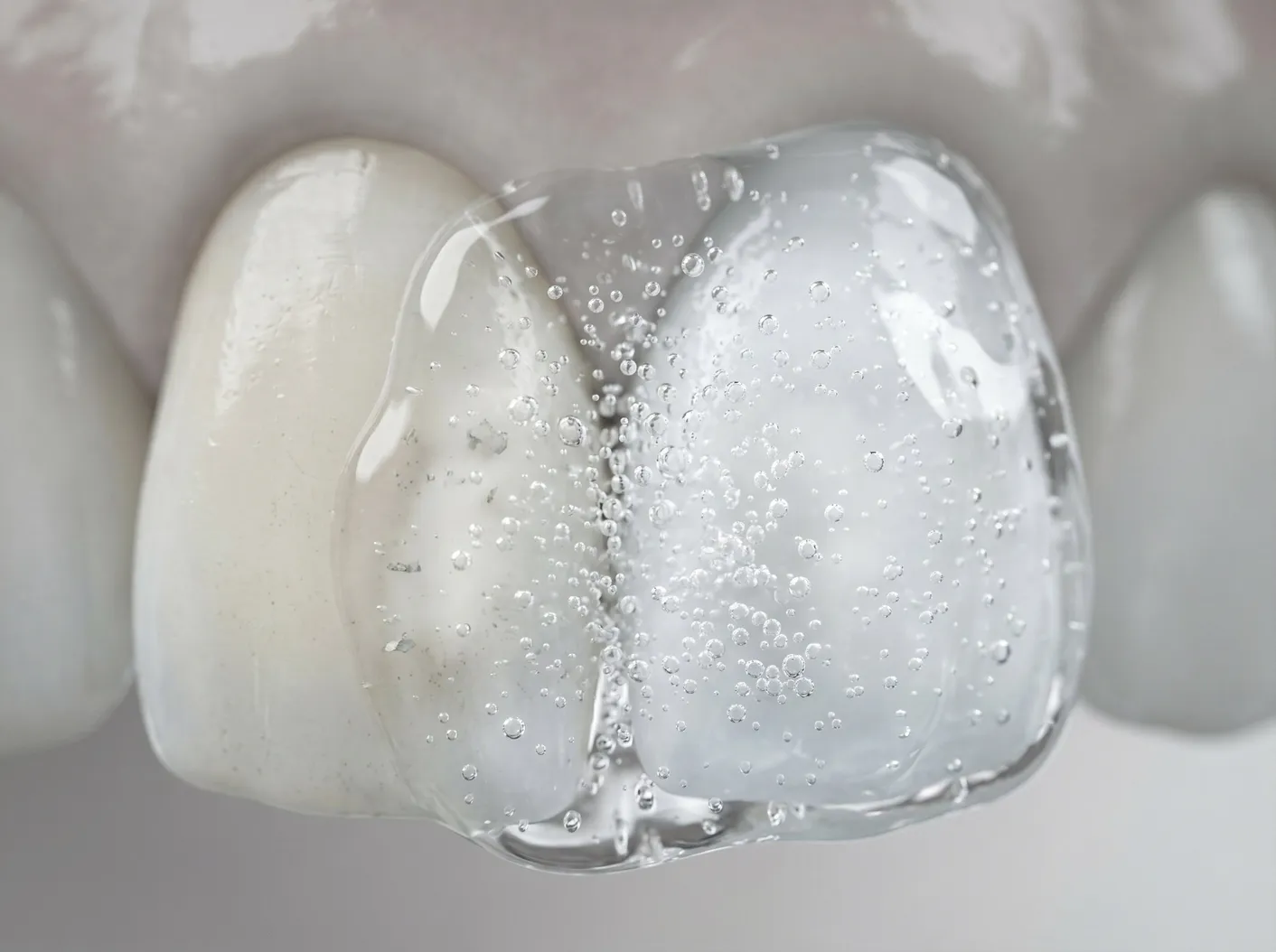 Zahnerkrankung und Bleaching: Das ist wichtig