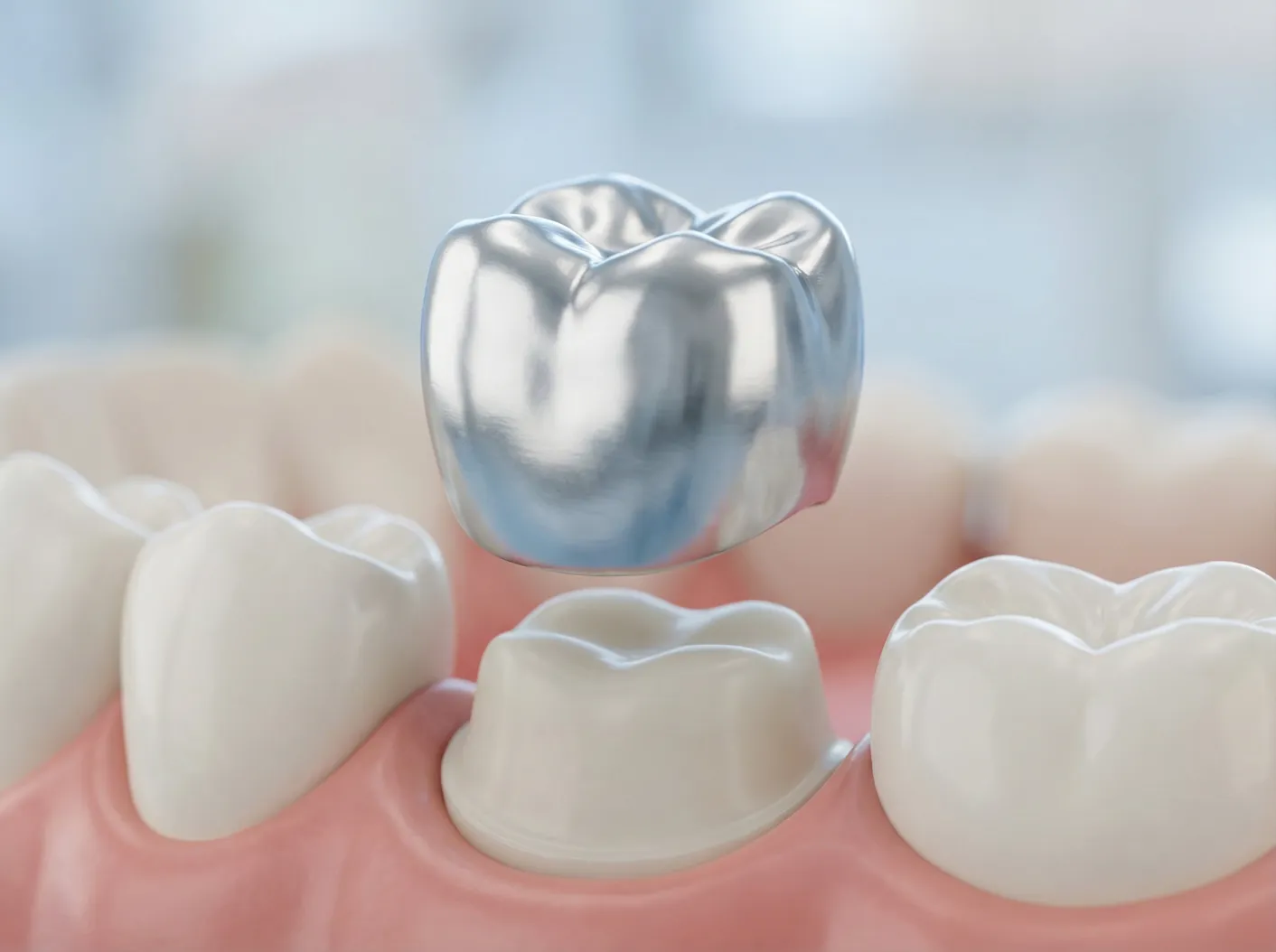 Was kostet eine Krone ohne Implantat?