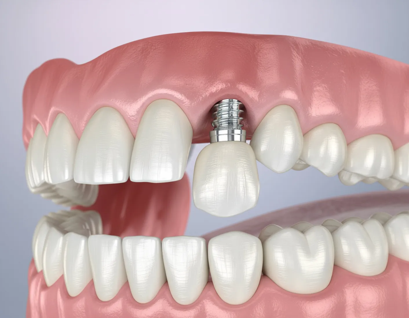Wie sieht ein Implantat ohne Krone aus