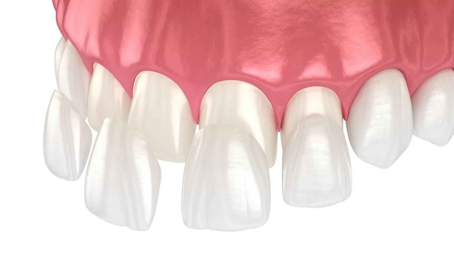 Veneers bei Zahnlücke: Was ist möglich?